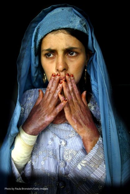 절박함으로 분신자살을 시도해 전신 70%에 화상을 입은 헤라트 여성. 미국 프리랜서 사진작가 폴라 브론스타인이 2004년 10월 22일 아프가니스탄 북서부의 도시 헤라트에서 촬영한 사진.  ⓒPaula Bronstein/Getty Images