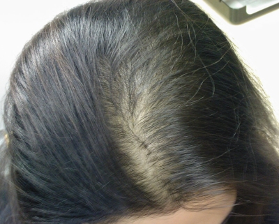 탈모 환자 중 여성 비중이 늘고 있다. 머리카락이 빠지는 것보다 가늘어지는 게 더 문제라는 게 전문가들의 지적이다. ⓒ뉴시스·여성신문